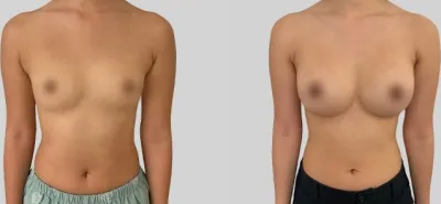 Before & After