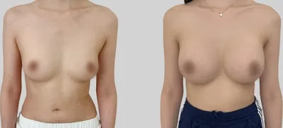 Before & After