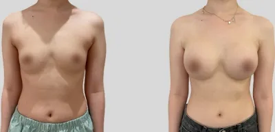 Before & After