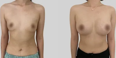 Before & After