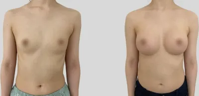 Before & After