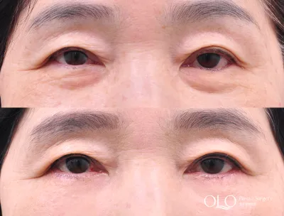 Before & After