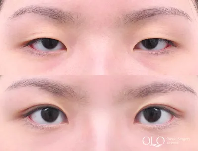 Before & After