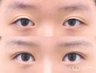 Before & After