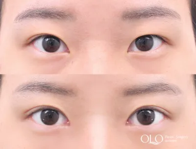Before & After