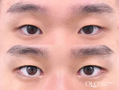 Before & After