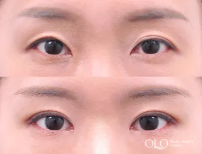 Before & After