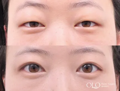 Before & After