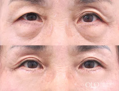 Before & After