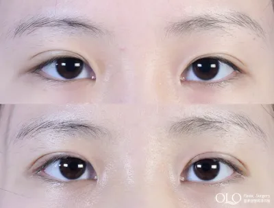 Before & After