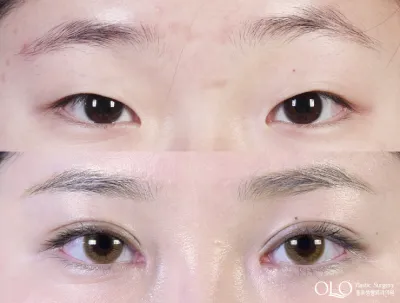 Before & After