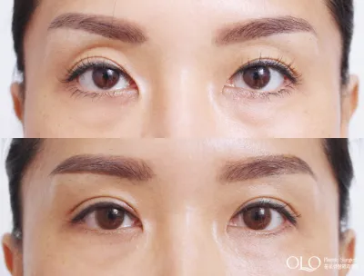 Before & After