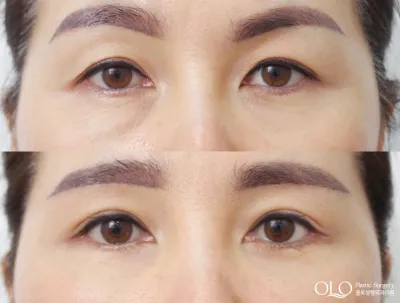 Before & After