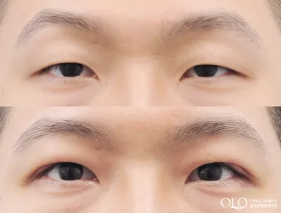 Before & After