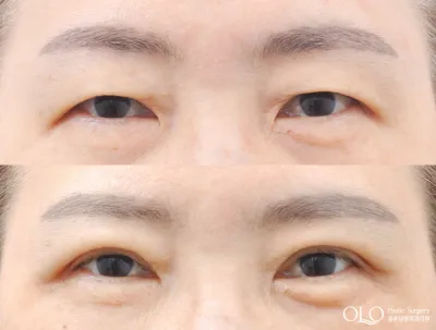 Before & After