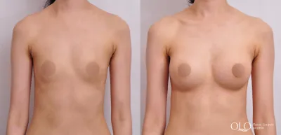 Before & After
