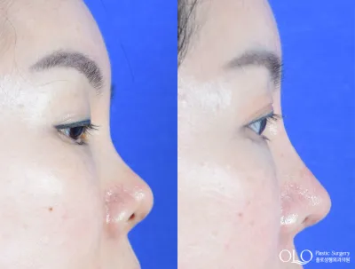 Before & After