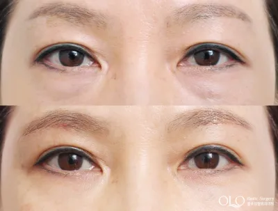 Before & After
