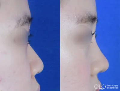Before & After