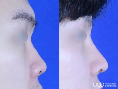 Before & After