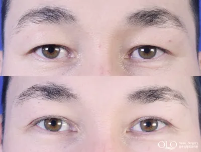 Before & After