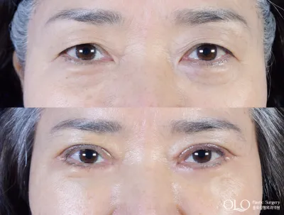 Before & After