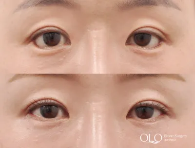 Before & After