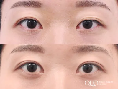 Before & After