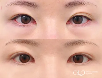 Before & After