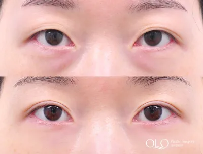 Before & After