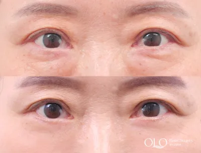 Before & After