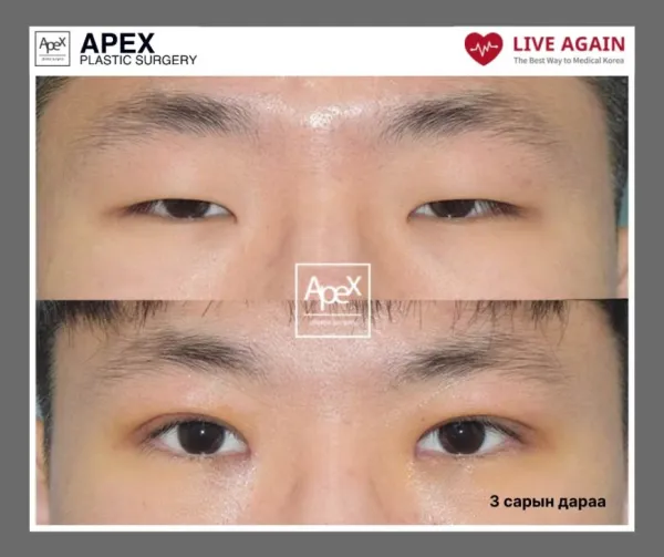 " Apex " Гоо сайхны мэс заслын эмнэлэг  Before & After 