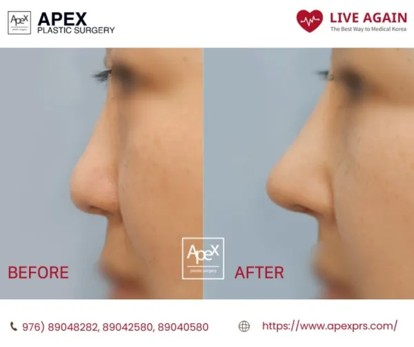 " Apex " Гоо сайхны мэс заслын эмнэлэг  Before & After 