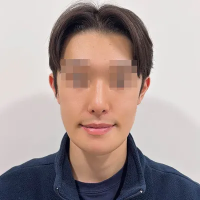 Нүүрний хэлбэр засах болон хамрын хагалгааг хамт хийлгэсэн!