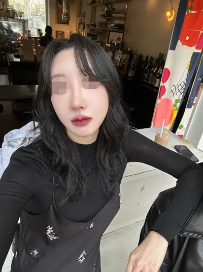 Ким Хён Ү эмчээр хамрын дахин мэс засал (өөрийн хавирганы мөгөөрс) хийлгэсэн сэтгэгдэл