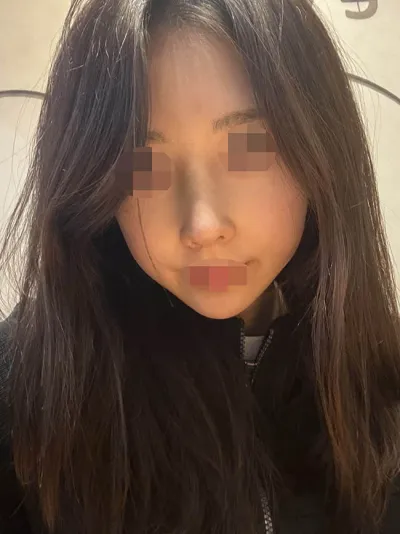 Вонт эмнэлэгт өөрийн хавирганы мөгөөрсөөр хамрын мэс засал хийлгэлээ!