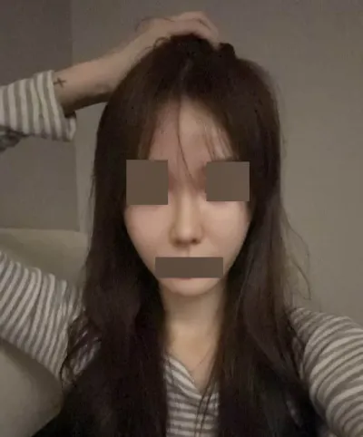 Хоёр дахь хамрын мэс заслаа Вонт эмнэлэгт амжилттай хийлгэлээ ^^