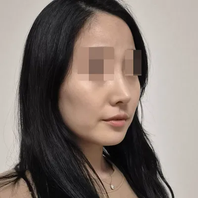 Анхны хамрын мэс заслаа Вонт эмнэлэгт хийлгэсэн! (хагалгааны дараах 5 дахь сар)