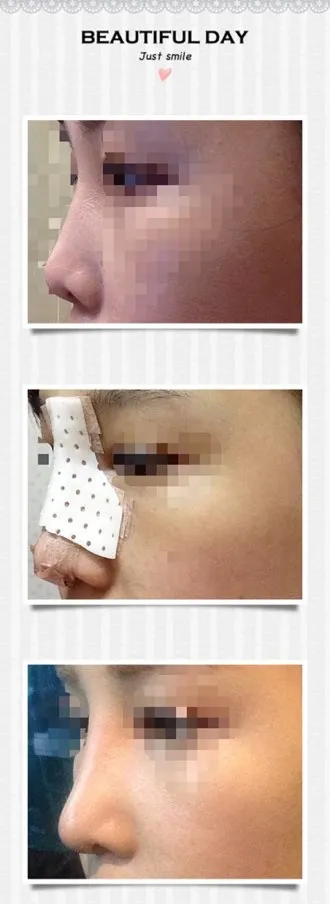 Хамрын хагалгаа хийлгээд 10 дахь хоног!!