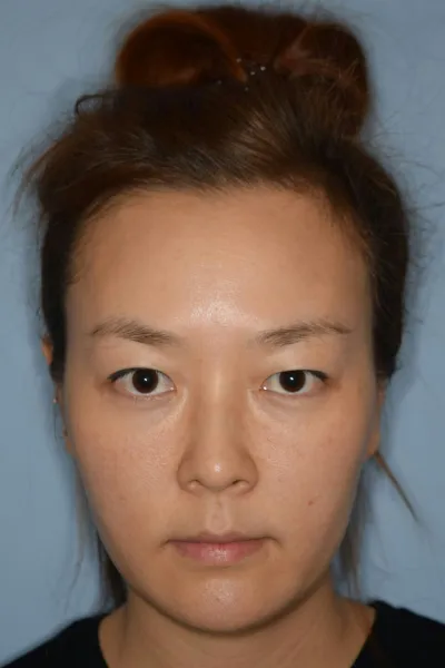 Хагалгаанд ороод аль хэдийн 3 сар өнгөрчээ. Энд тэндхийн эмнэлгүүдийг маш сайн судалж, очиж үзэж, зөвлөгөө ч авч үзсэн... Гэхдээ нэг их таалагдах газар байгаагүй. Хагалгаа хийлгэх эсэхдээ эргэлзэж байсан болохоор, буруу болоод гаж нөлөө илрэх вий гэж