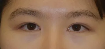 Эцэст нь зүсэлтгүйгээр нүдний хэлбэр засах хагалгаа хийлгэлээㅋㅋㅋㅋㅋ