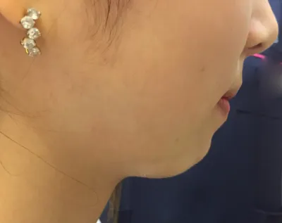 Би эрүүгүй шахуу байсан болохоор эхлээд эрүүний үзүүр засах хагалгаа хийлгэх талаар ч бодож байсан.