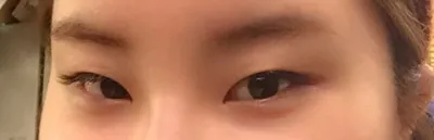 Би зөвхөн нүдний булан нээх хагалгаа хийлгэсэн боловч нүд маань ингэж өөрчлөгдлөө.