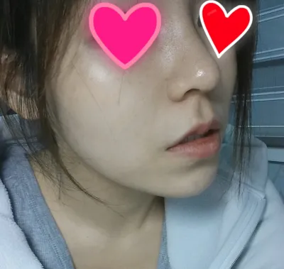 Сайн байна уу? Хамар засвар хийлгэснээс хойш долоо хоног хэртэй болж байгаа ч маш хөнгөн болсон болохоор сайрхахаар ирлээ.