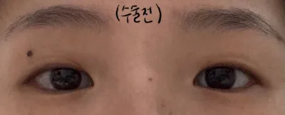 Будагтай зовхи + урд зүсэлт хийлгэсэн тухай сэтгэгдэл