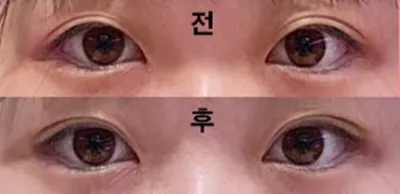 Булгараар мэс засал хийлгэсэн!