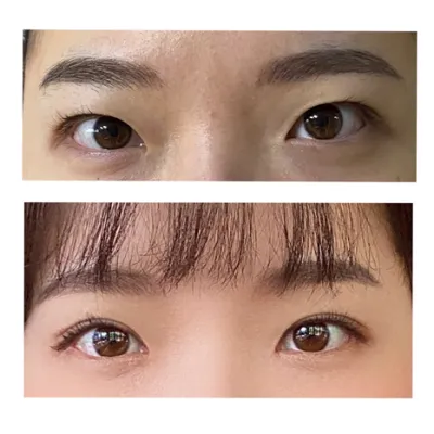 Давхар зовхины оёдол + урд зовхины зүслэг хийлгэсний дараах 2 сарын сэтгэгдэл!