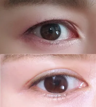 Зүсэлттэй зовхины заслын үр дүнд сэтгэл хангалуун байна!