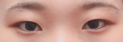 Зүсэлттэй хос зовхи, урд зовхины мэс засал хийлгээд сар болж байна