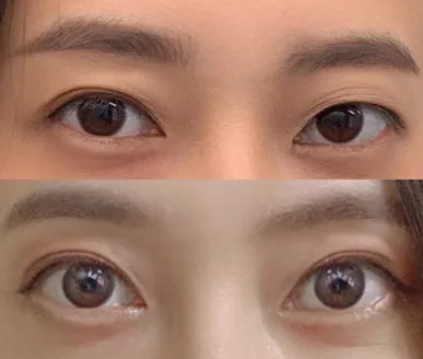 Давтан хагалгааны 6 сарын дараах сэтгэгдэл